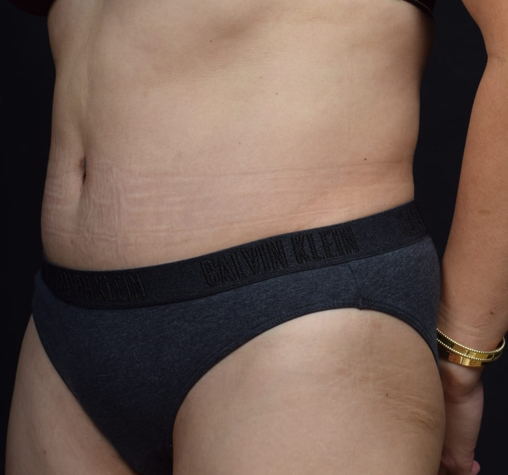 Patient 71 gallery after b