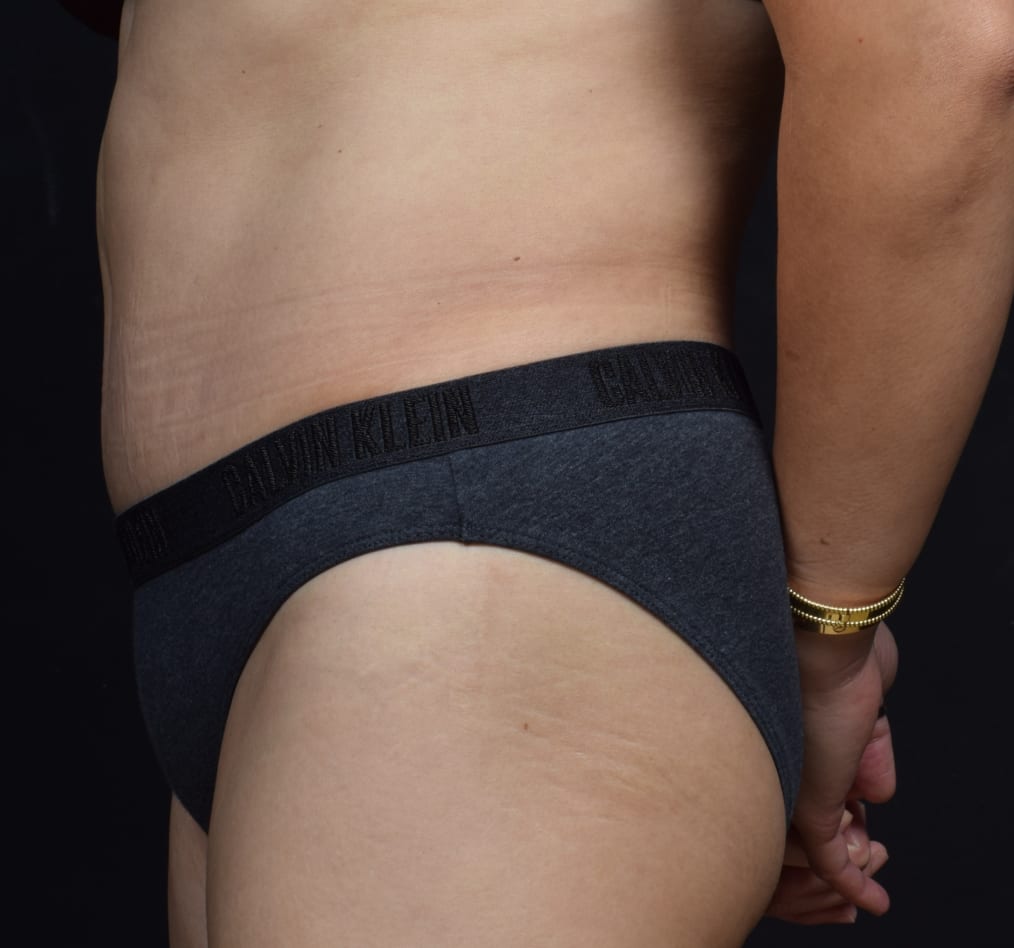 Patient 71 gallery after d