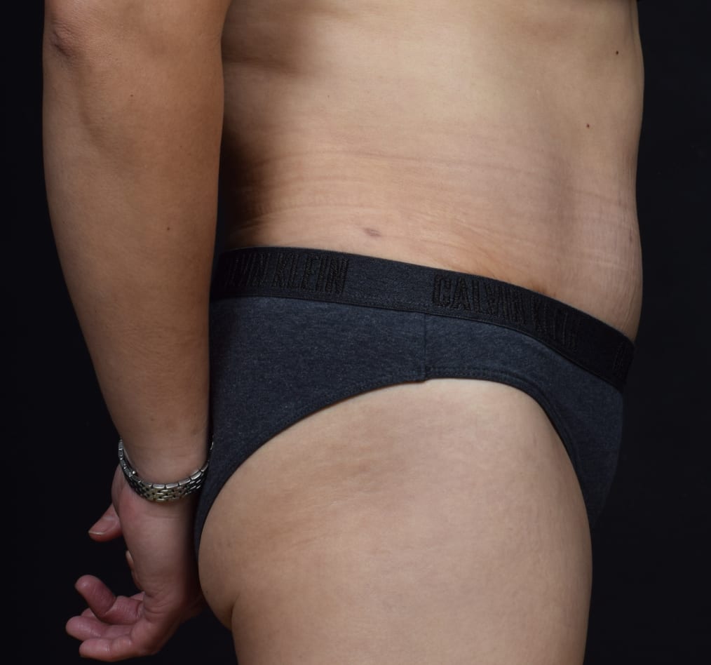 Patient 71 gallery after e