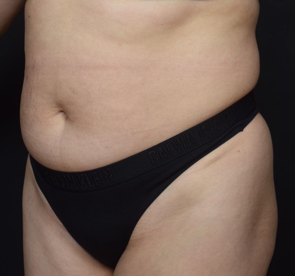 Patient 71 gallery before b