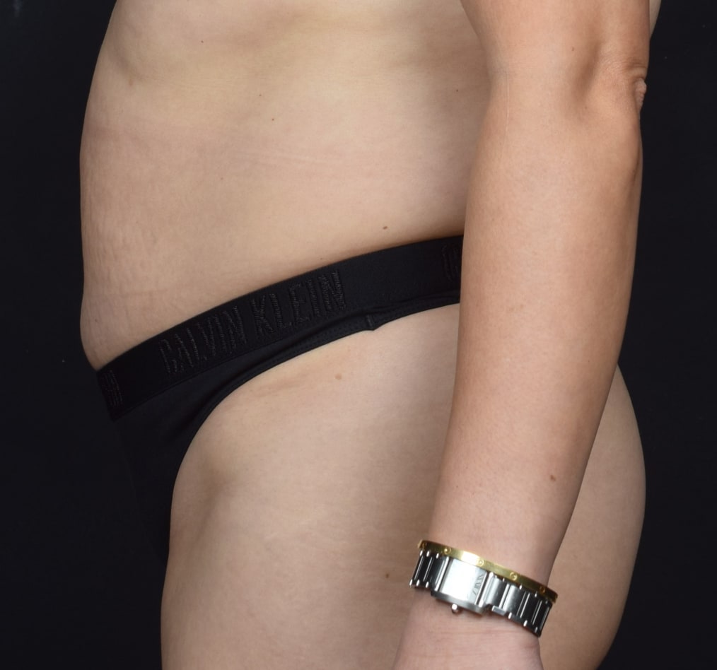 Patient 71 gallery before d