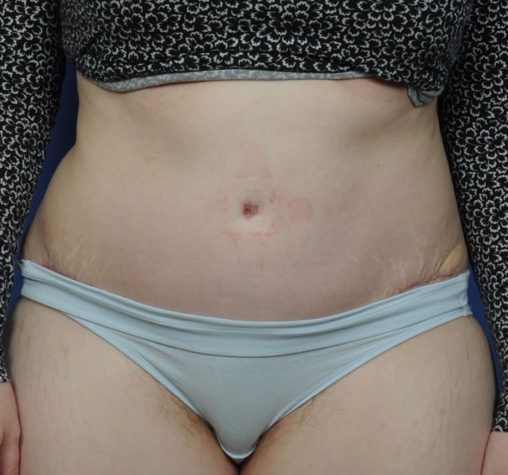 Patient 72 gallery after a