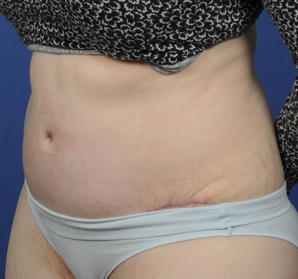 Patient 72 gallery after b