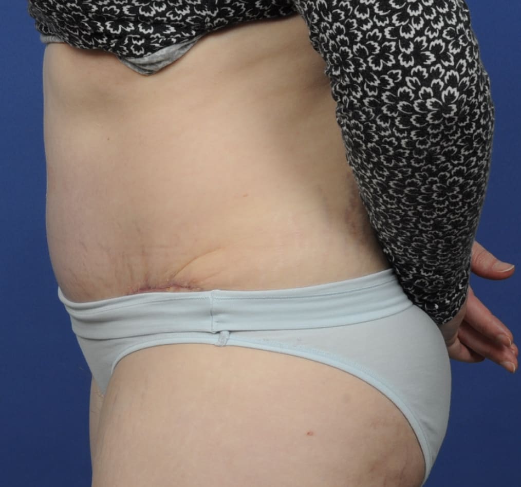 Patient 72 gallery after d