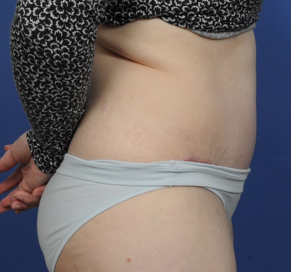 Patient 72 gallery after e