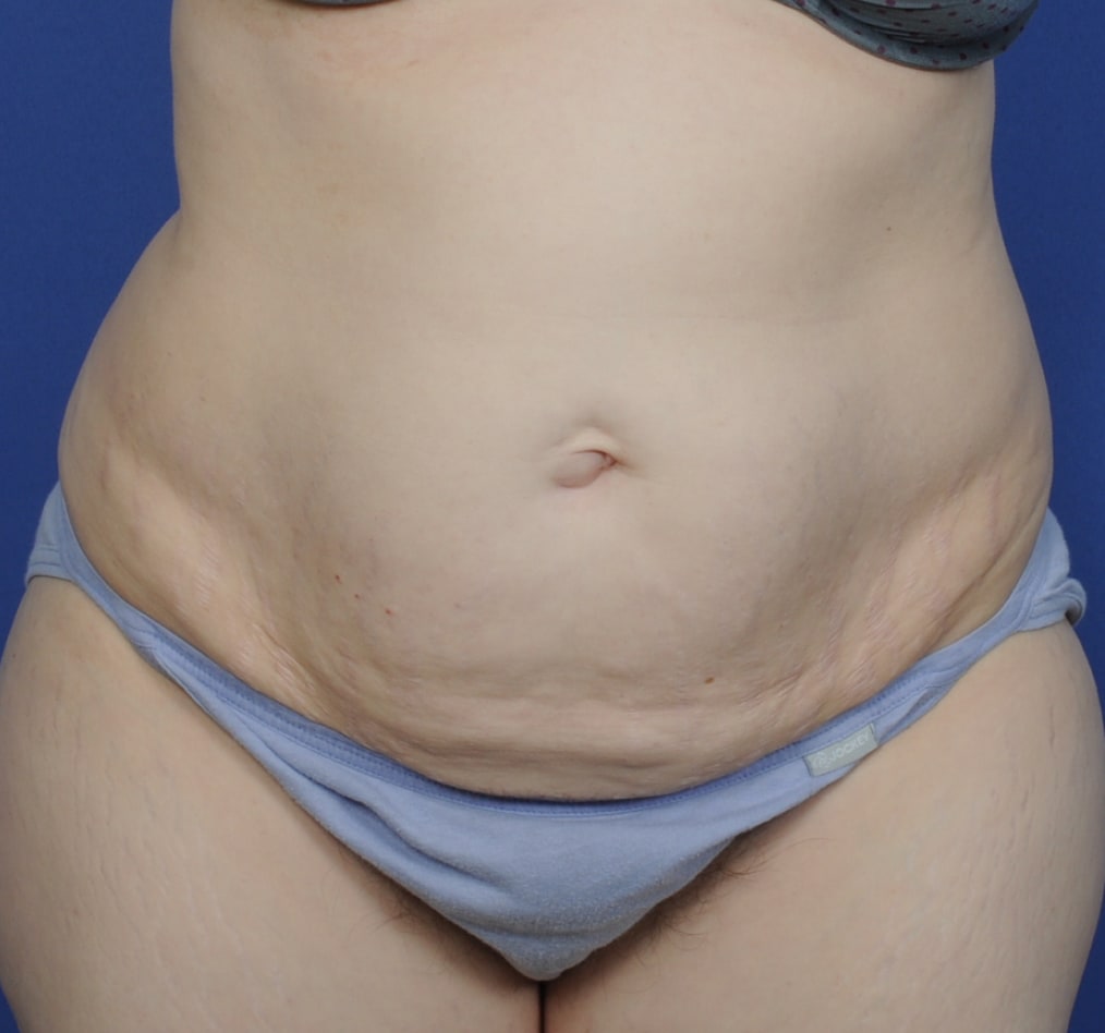 Patient 72 gallery before a