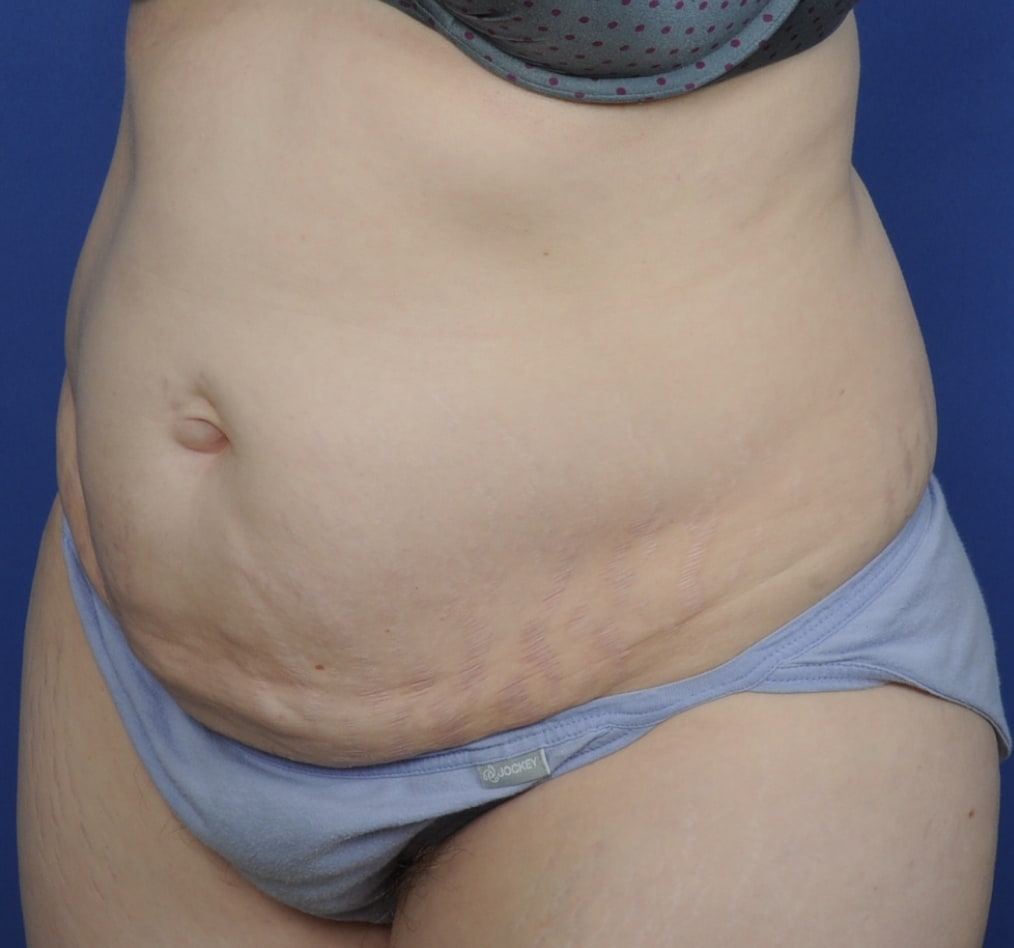 Patient 72 gallery before b