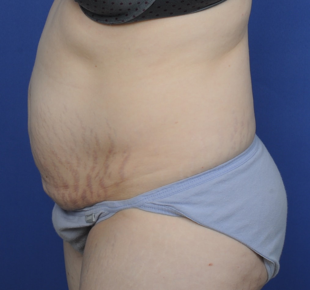 Patient 72 gallery before d