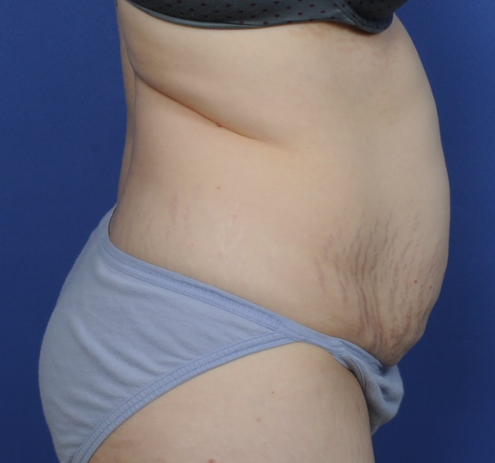 Patient 72 gallery before e