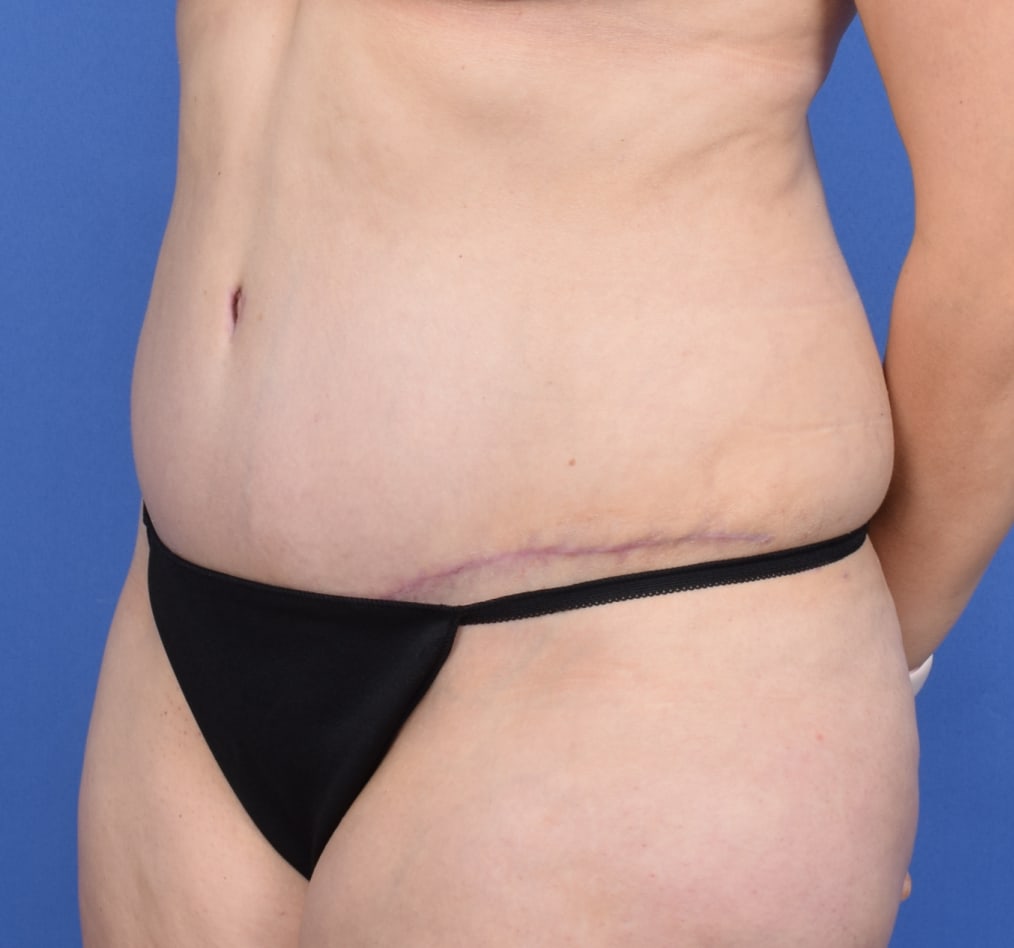 Patient 73 gallery after b