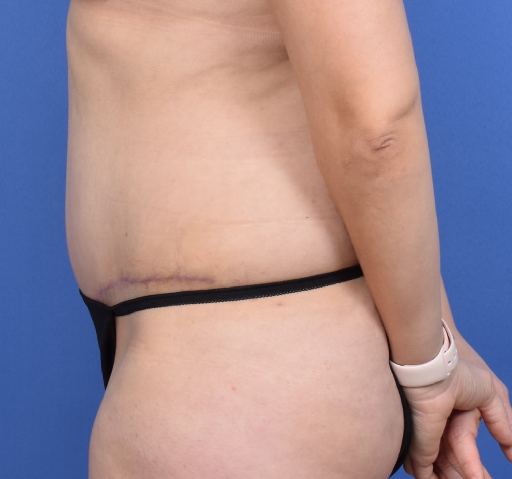 Patient 73 gallery after d