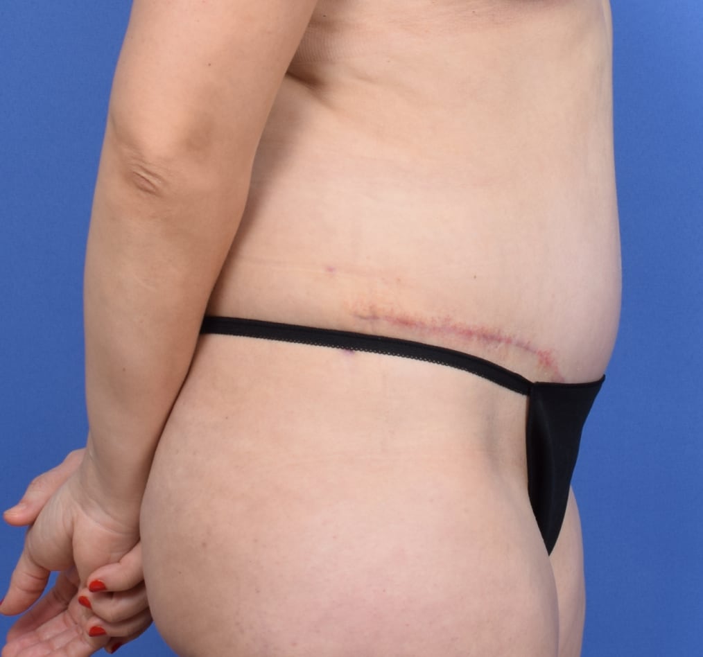 Patient 73 gallery after e