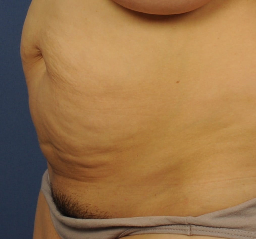 Patient 73 gallery before b