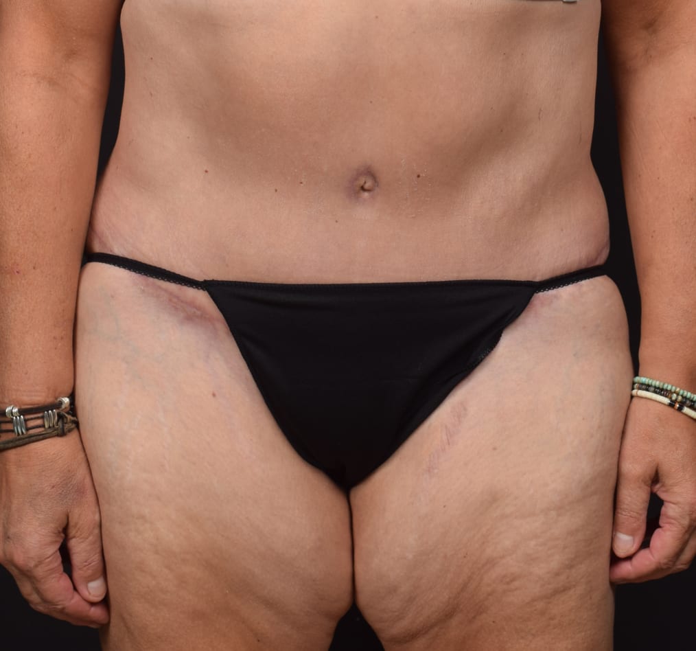 Patient 74 gallery after a