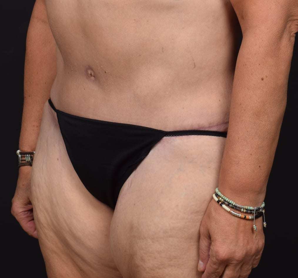 Patient 74 gallery after b