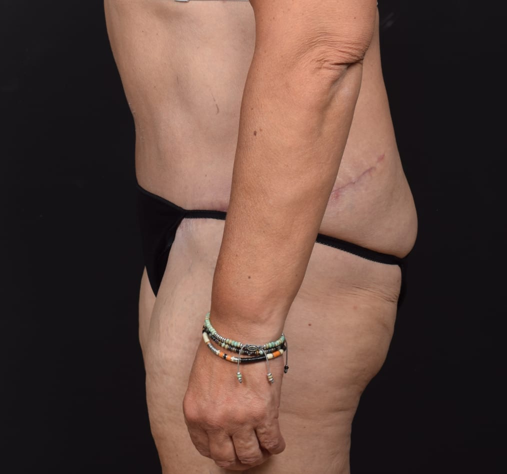 Patient 74 gallery after d