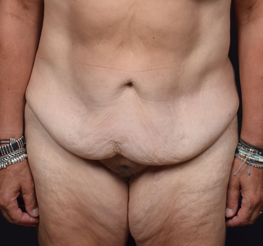 Patient 74 gallery before a