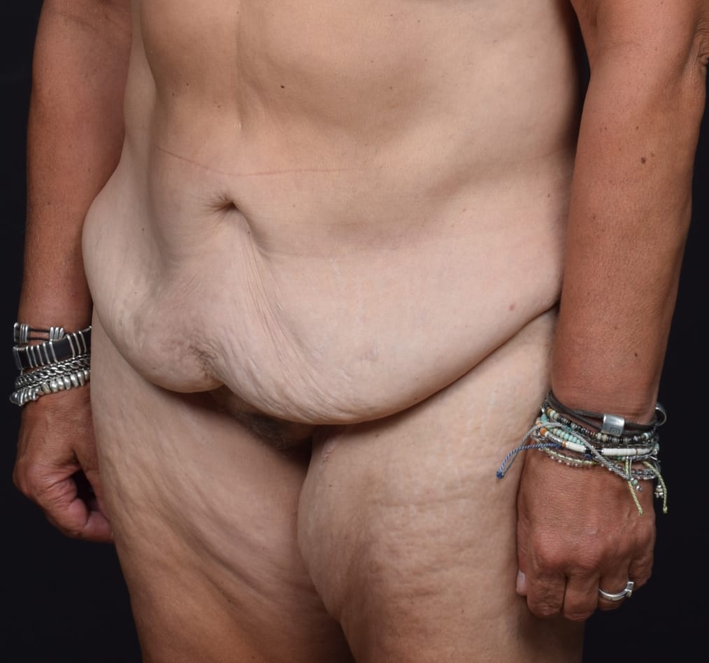 Patient 74 gallery before b