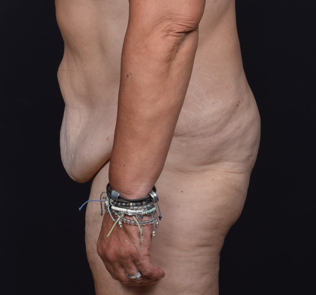 Patient 74 gallery before d