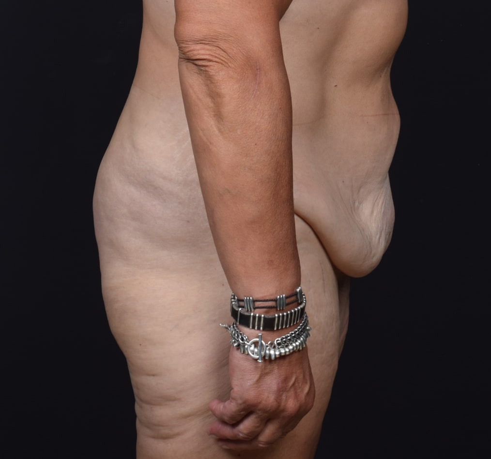 Patient 74 gallery before e