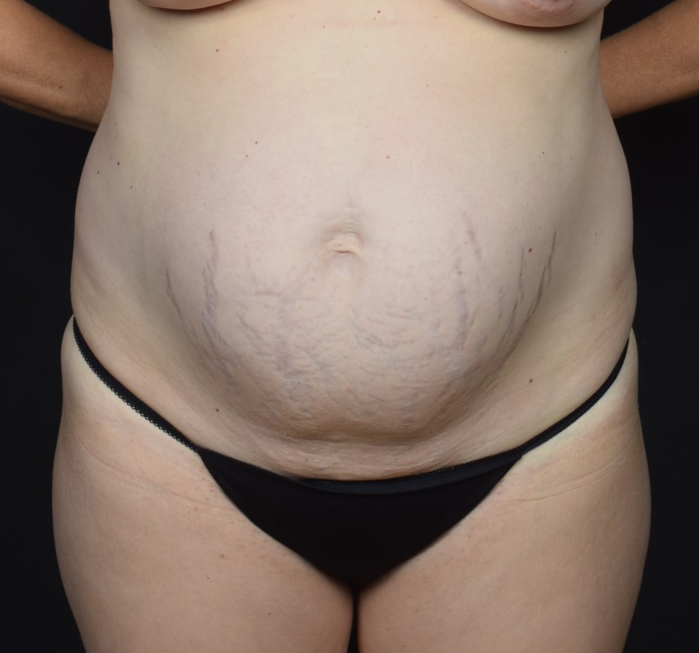 Patient 76 gallery before a