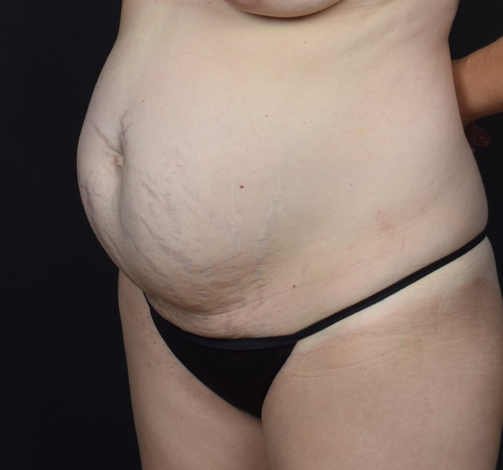 Patient 76 gallery before b