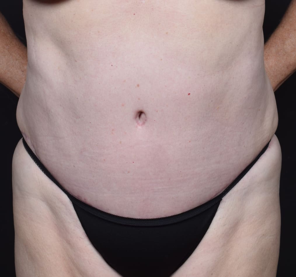 Patient 77 gallery after a