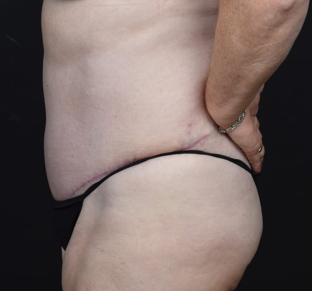 Patient 77 gallery after d