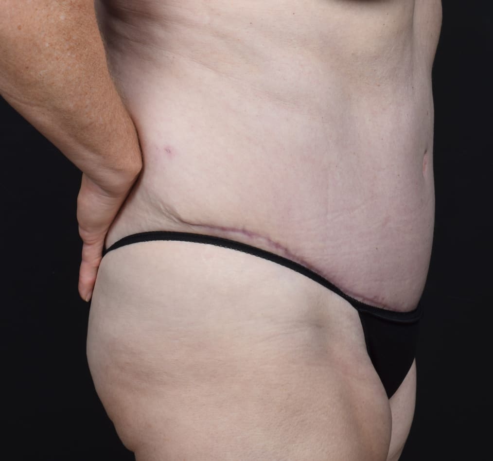 Patient 77 gallery after e