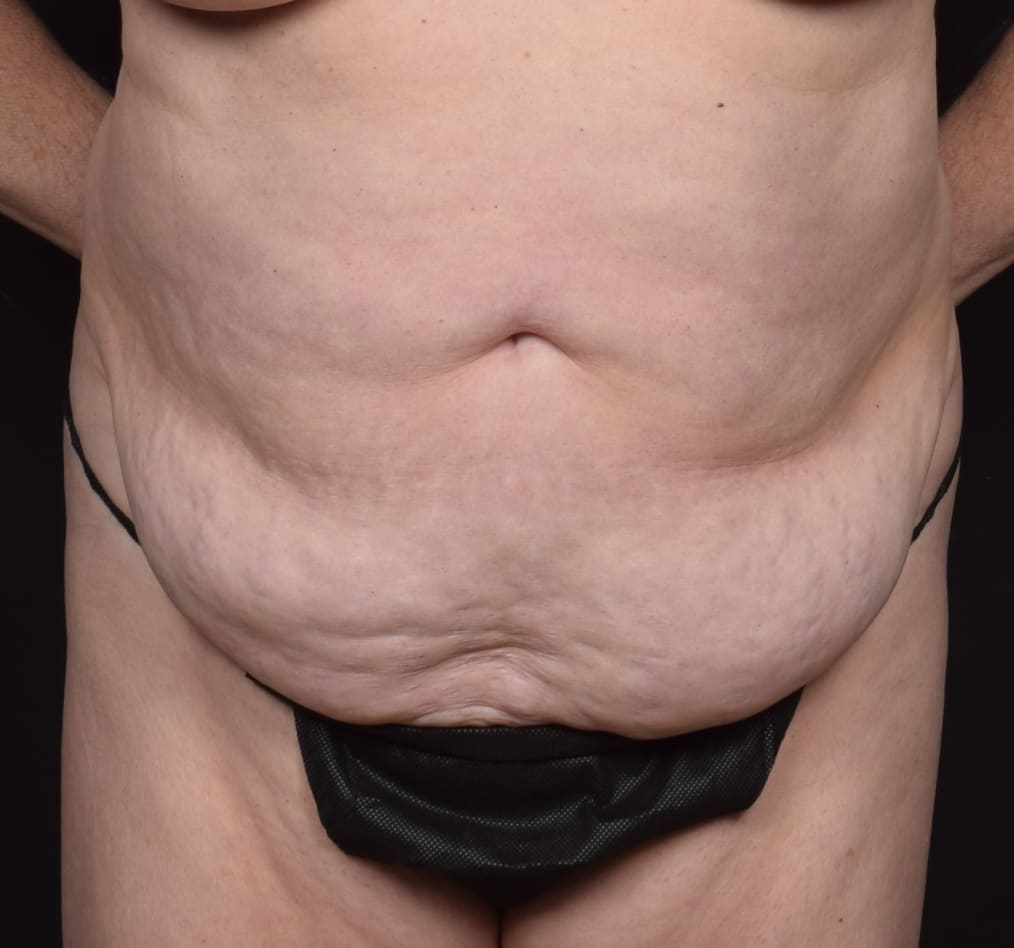 Patient 77 gallery before a