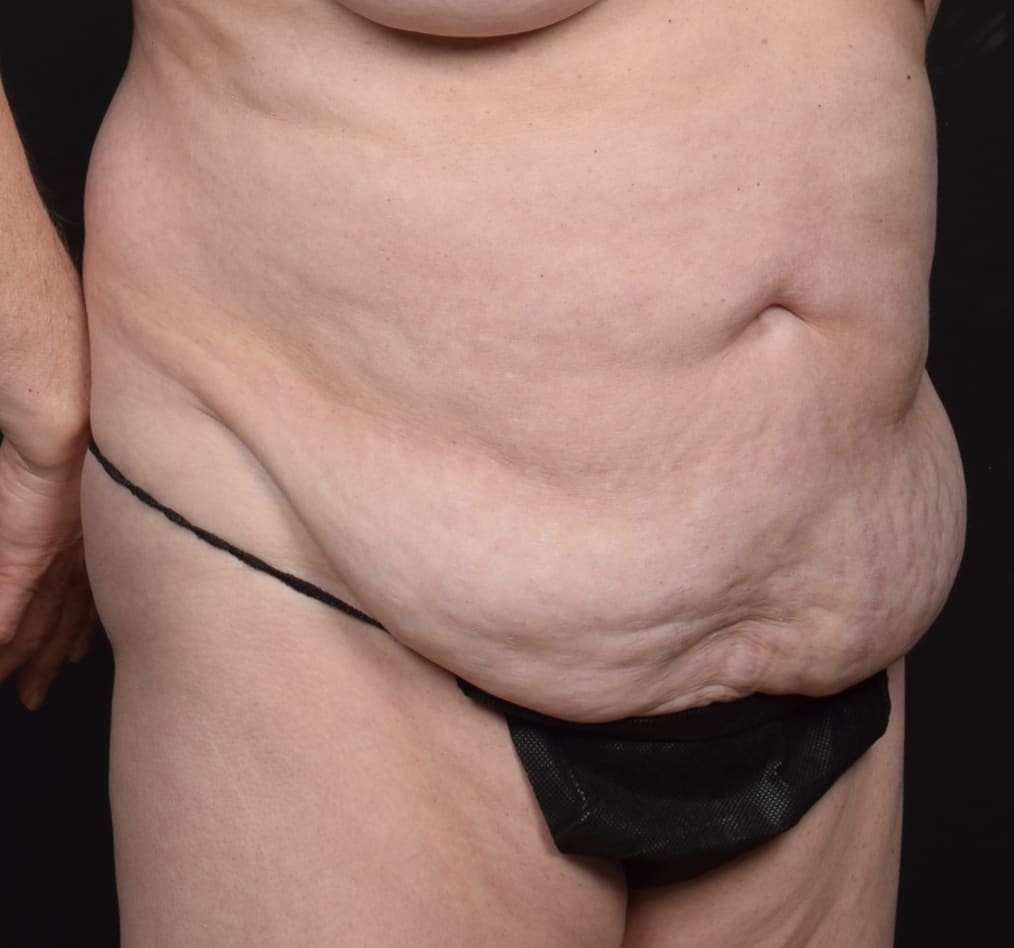 Patient 77 gallery before c