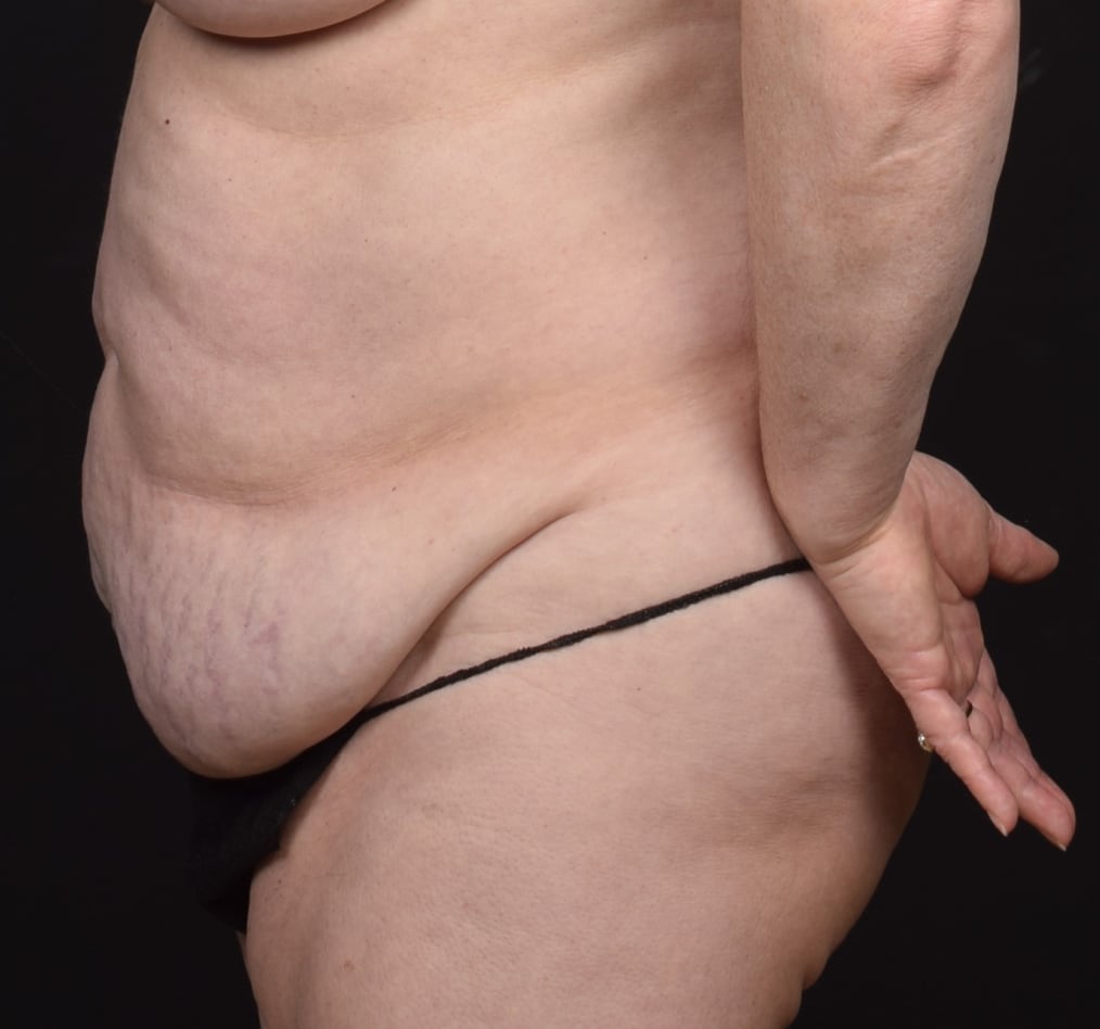 Patient 77 gallery before d