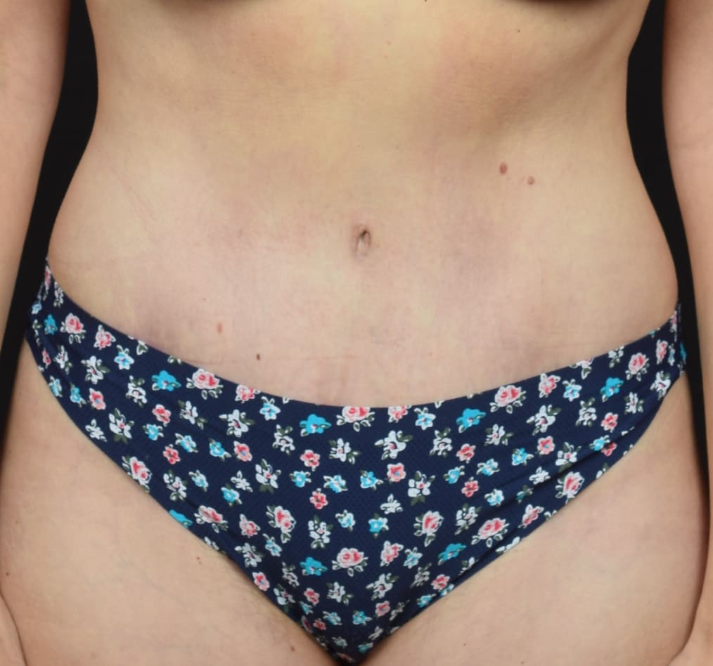 Patient 78 gallery after a