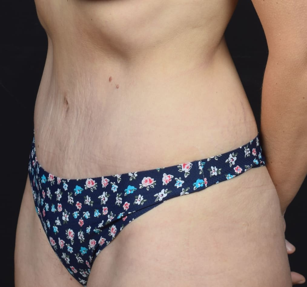 Patient 78 gallery after b