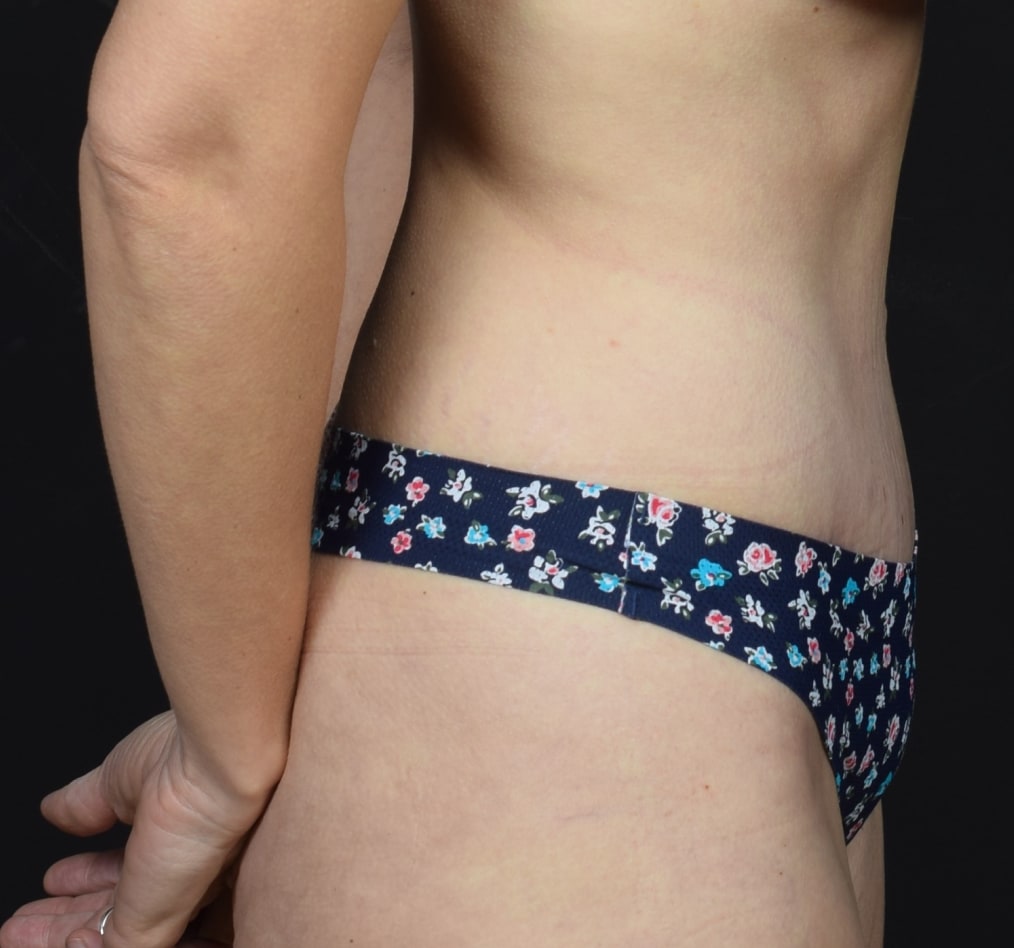 Patient 78 gallery after e