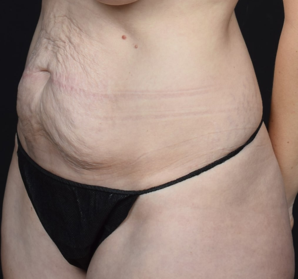 Patient 78 gallery before b