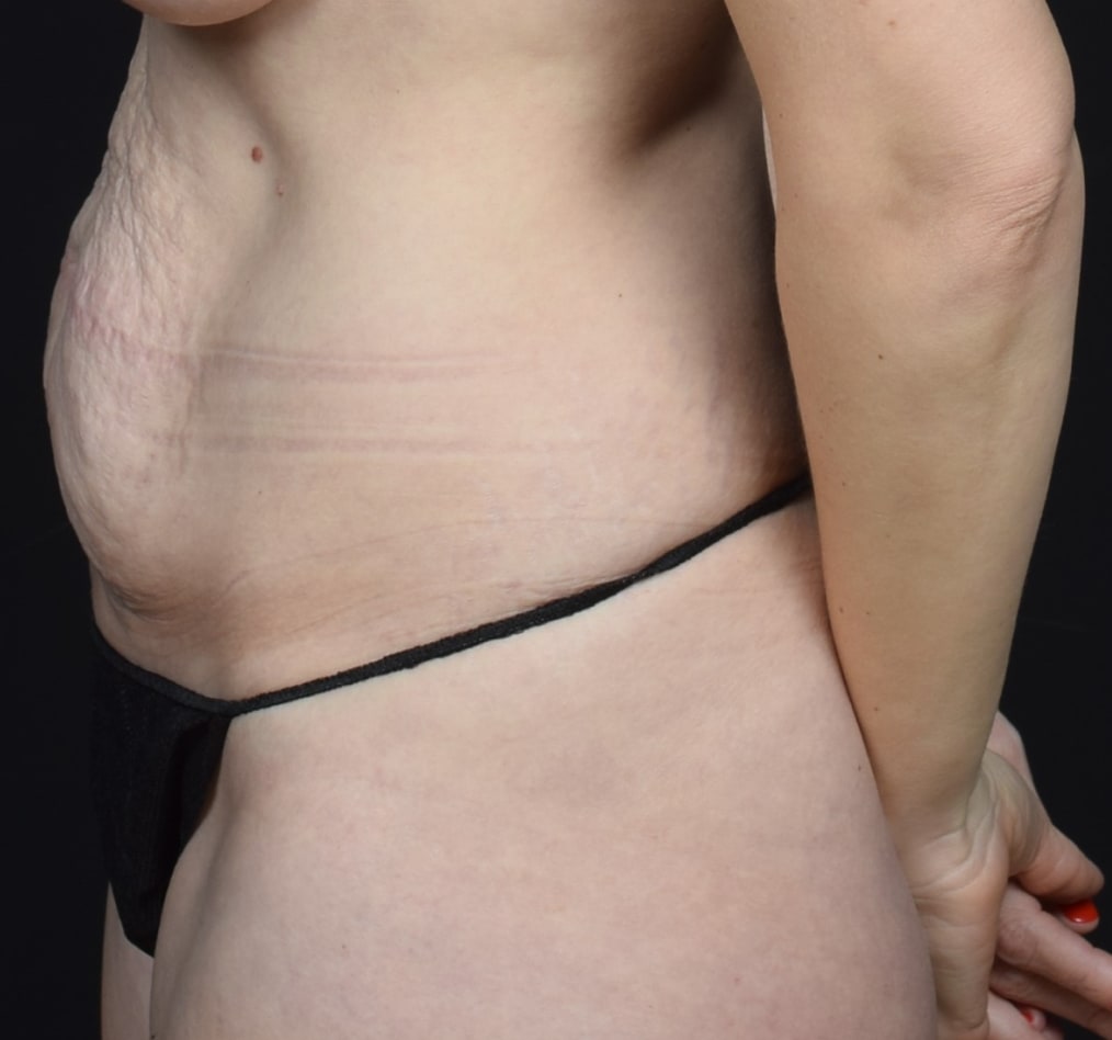 Patient 78 gallery before d