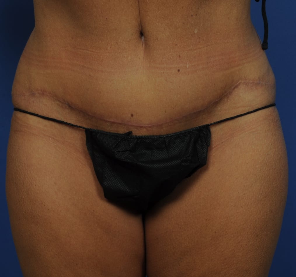 Patient 79 gallery after a