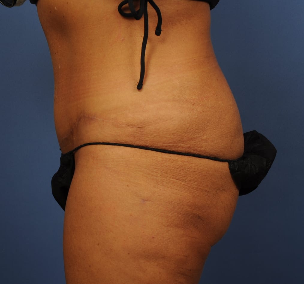 Patient 79 gallery after d