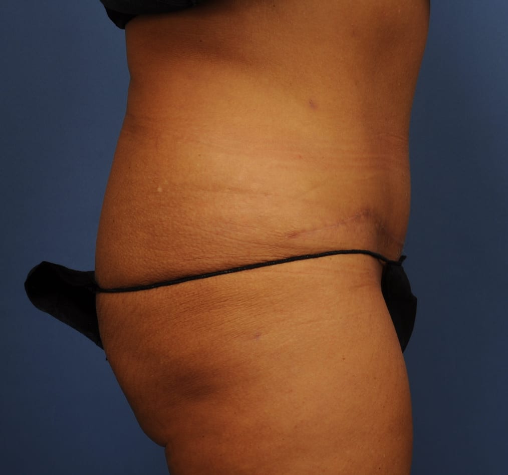 Patient 79 gallery after e