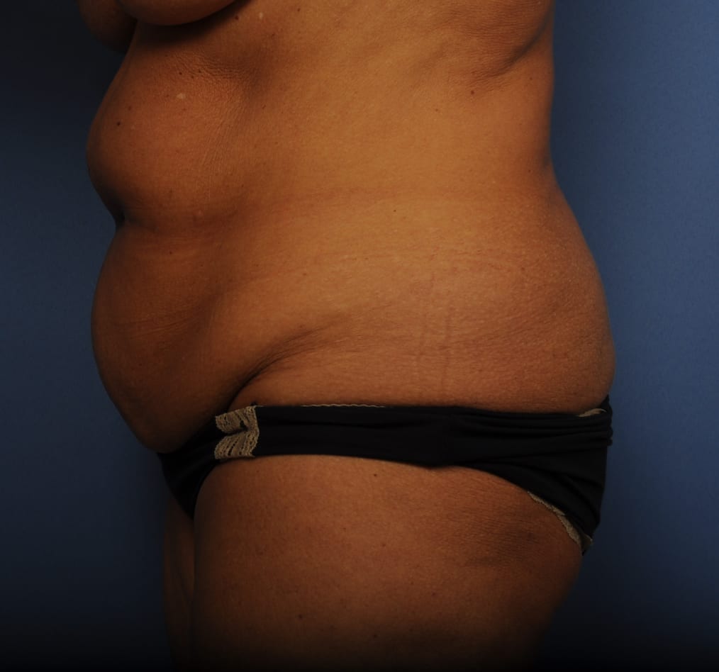 Patient 79 gallery before d