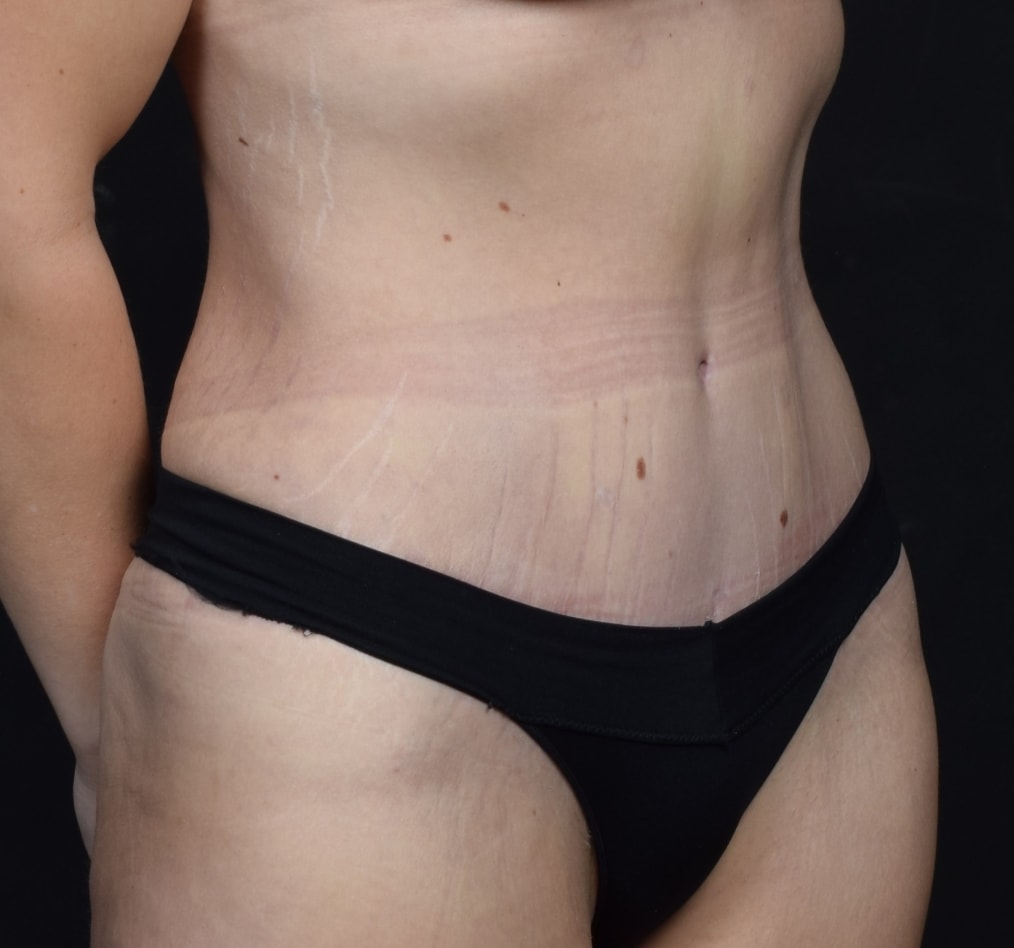 Patient 123 gallery after c