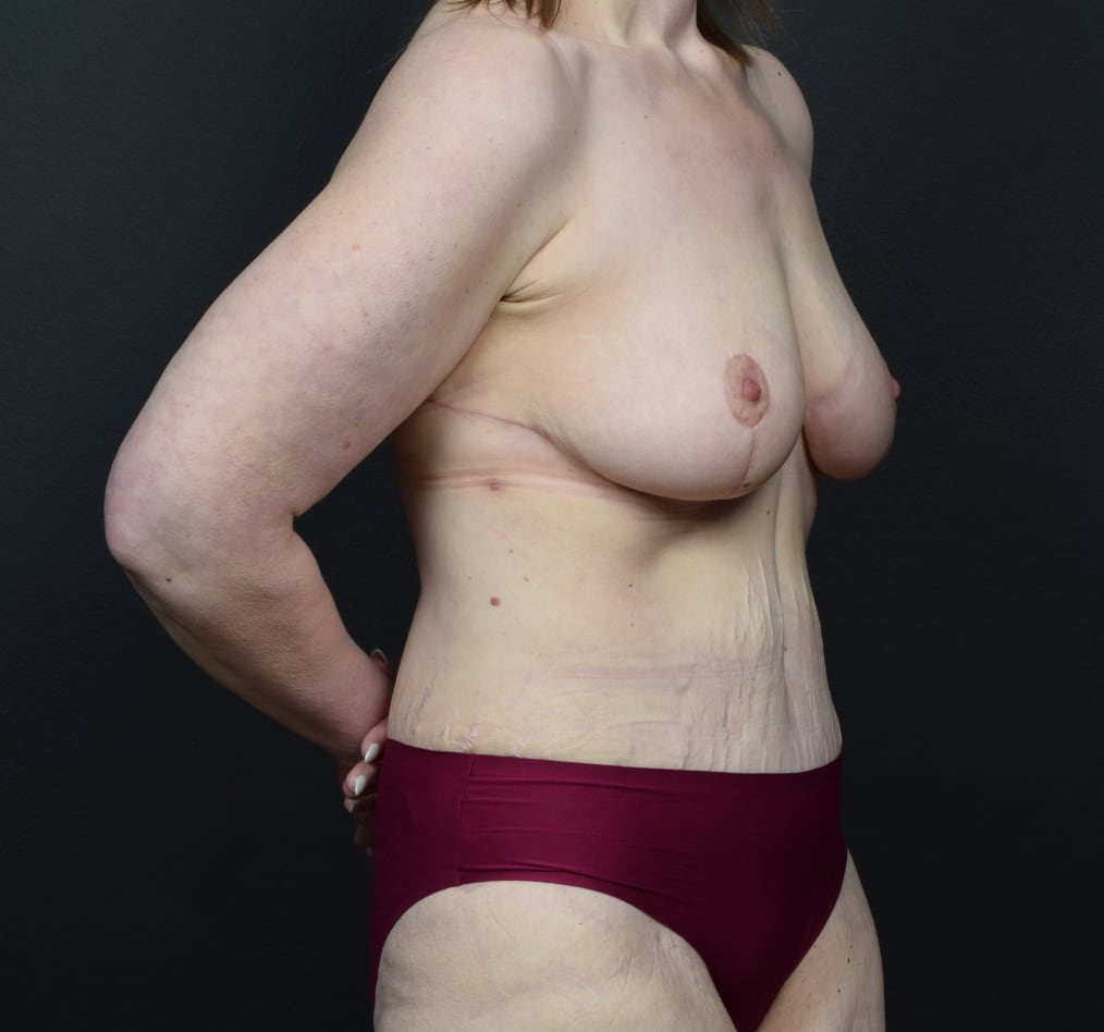 Patient 127 gallery after c