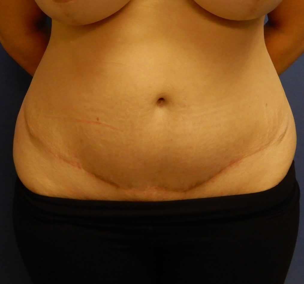 Patient 65 gallery after a