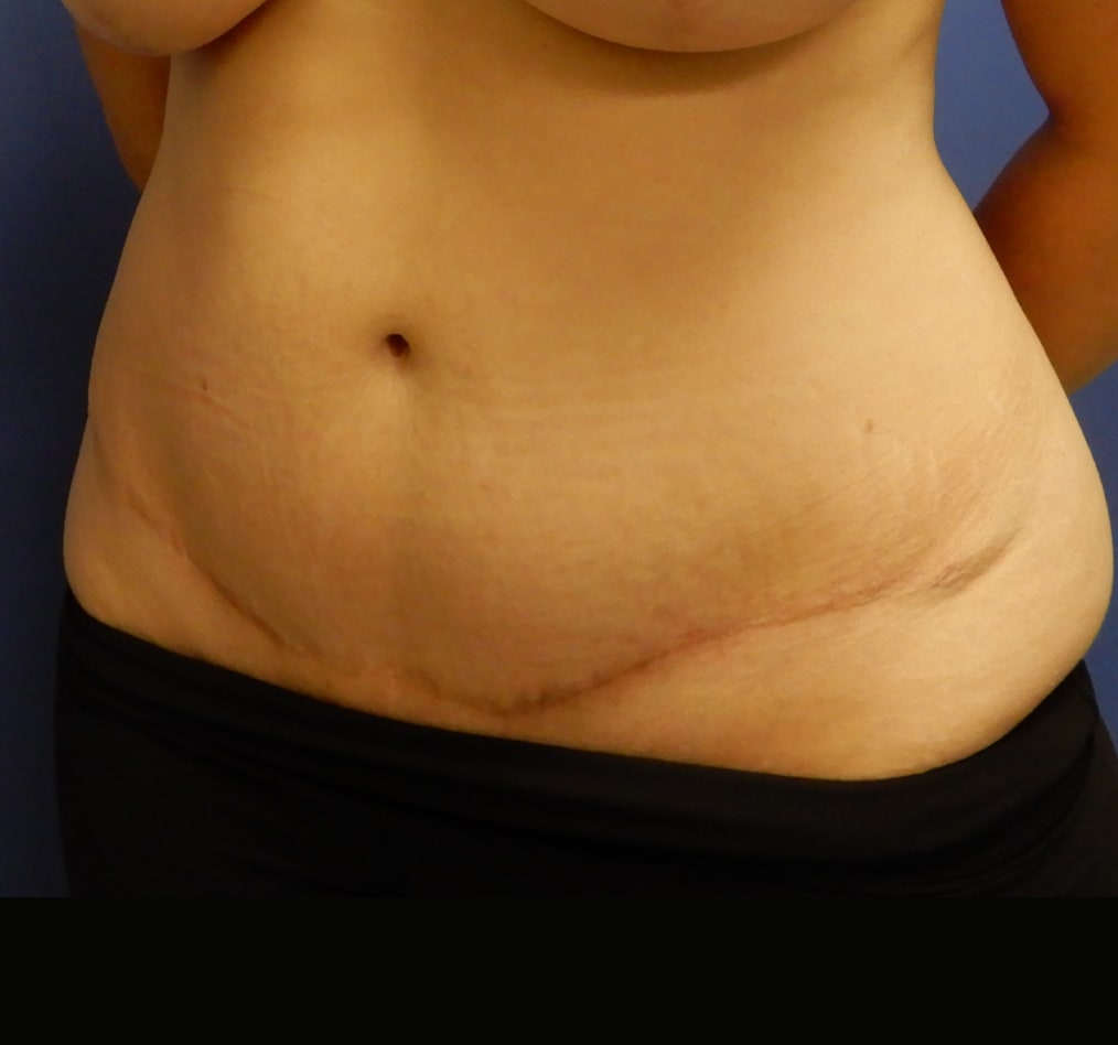 Patient 65 gallery after b