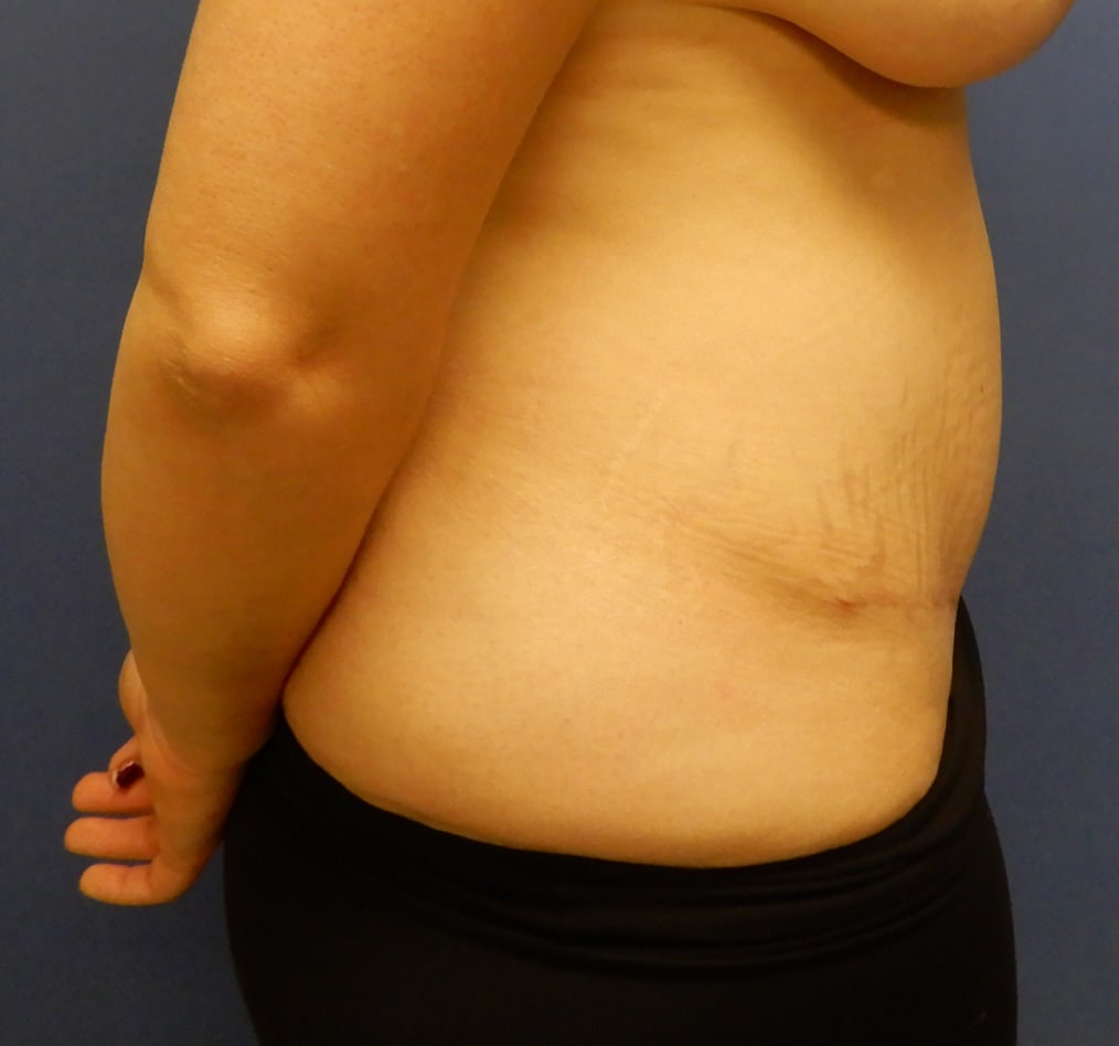 Patient 65 gallery after e