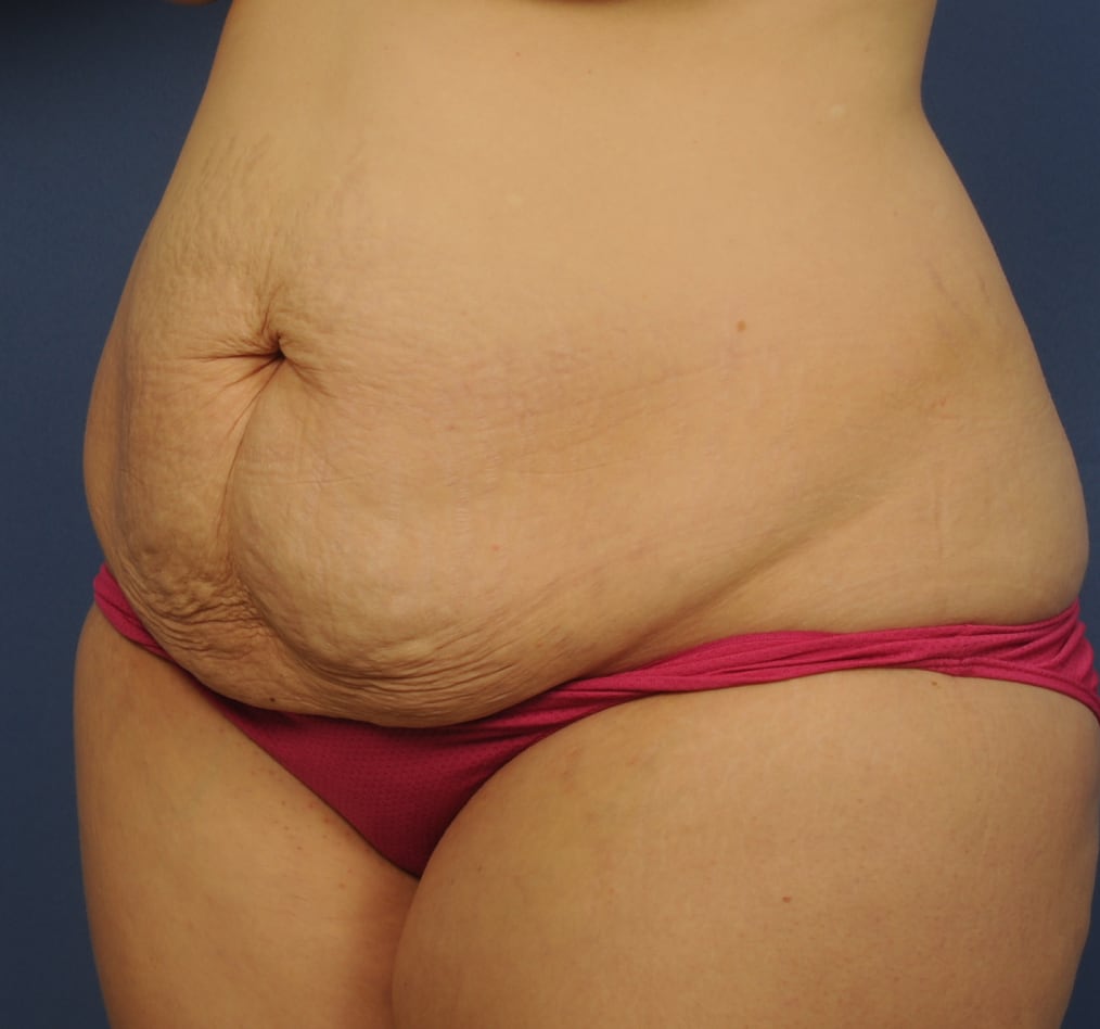 Patient 65 gallery before b