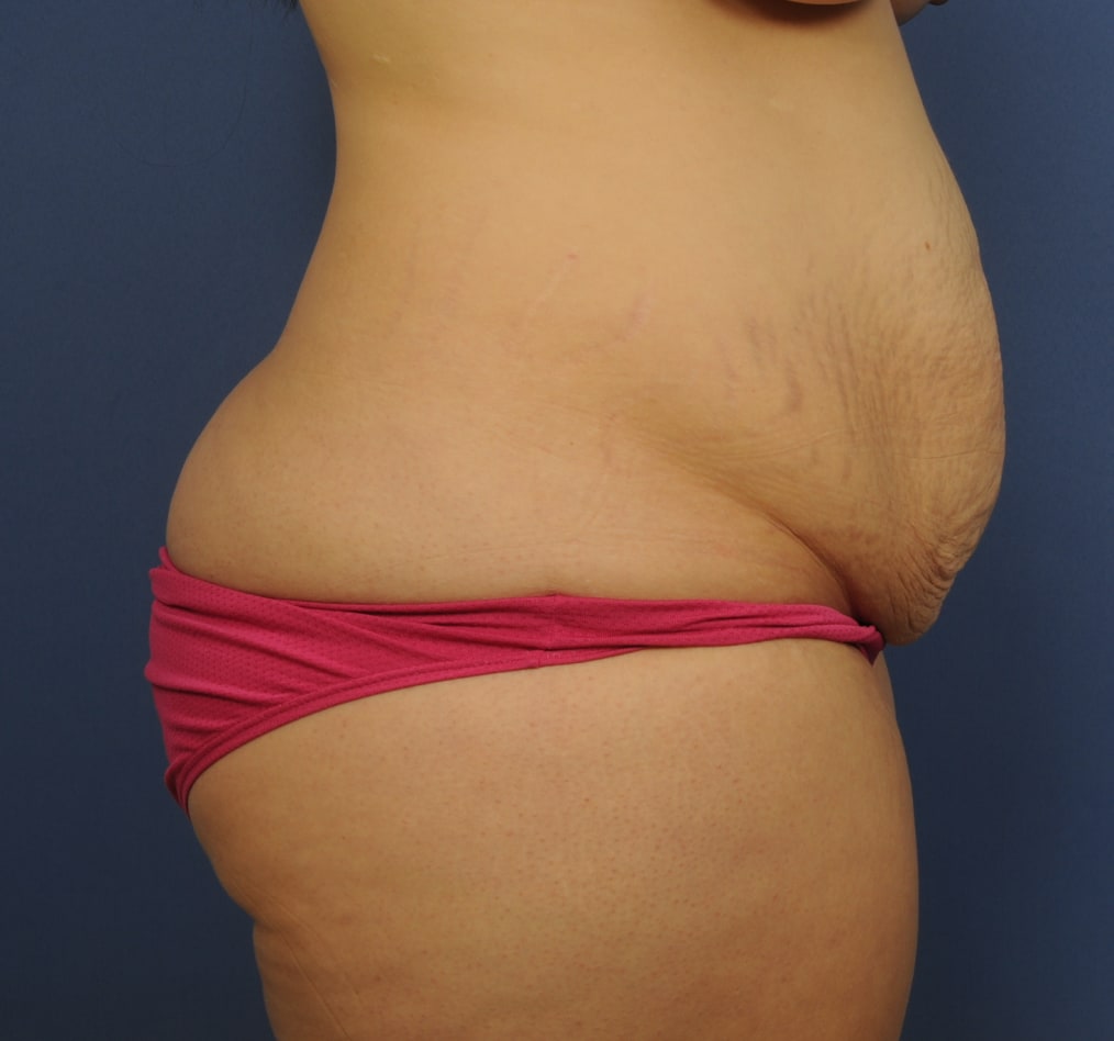 Patient 65 gallery before e