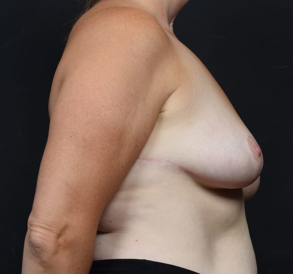 Patient 125 gallery after e