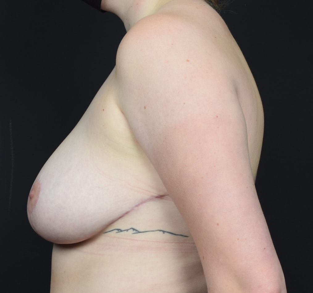 Patient 38 gallery after d